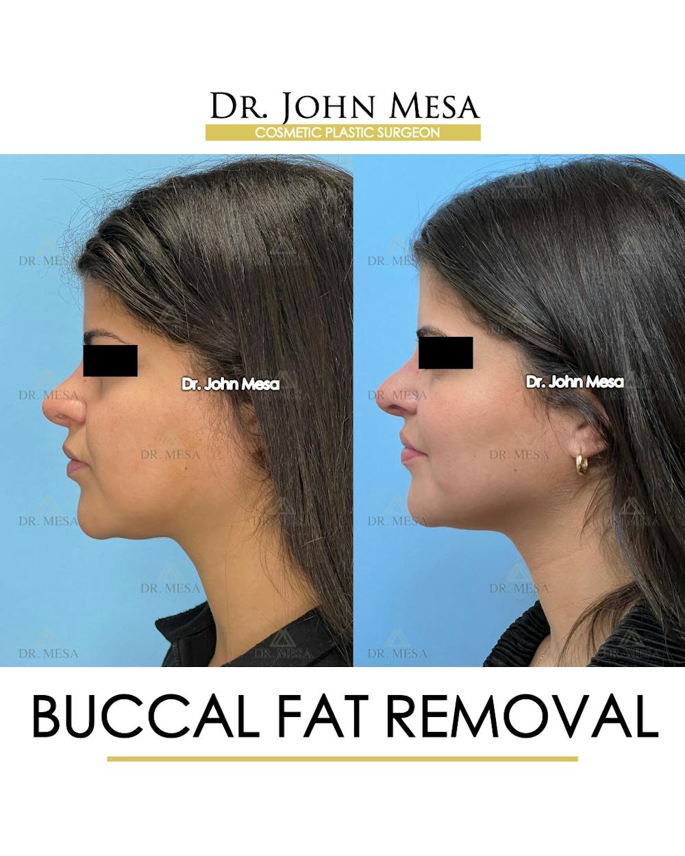Buccal Fat Pad Removal Before & After Gallery - Patient 165538 - Image 6