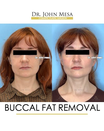Buccal Fat Pad Removal Before & After Gallery - Patient 209841 - Image 1