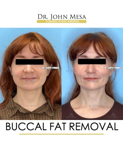 Buccal Fat Pad Removal Before & After Gallery - Patient 209841 - Image 2
