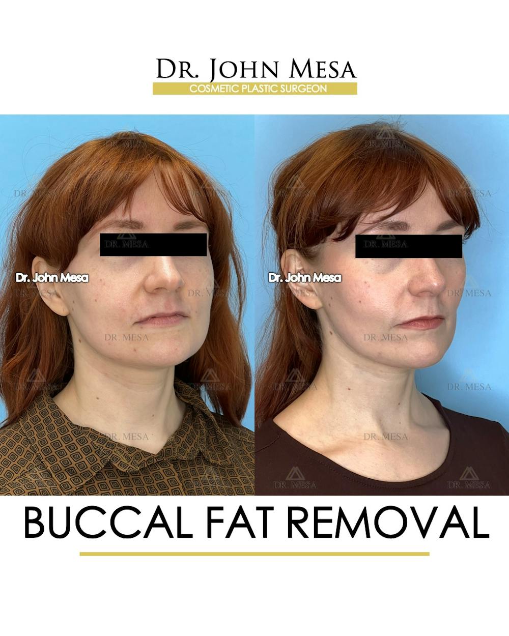 Buccal Fat Pad Removal Before & After Gallery - Patient 209841 - Image 3