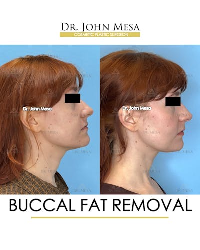 Buccal Fat Pad Removal Before & After Gallery - Patient 209841 - Image 4