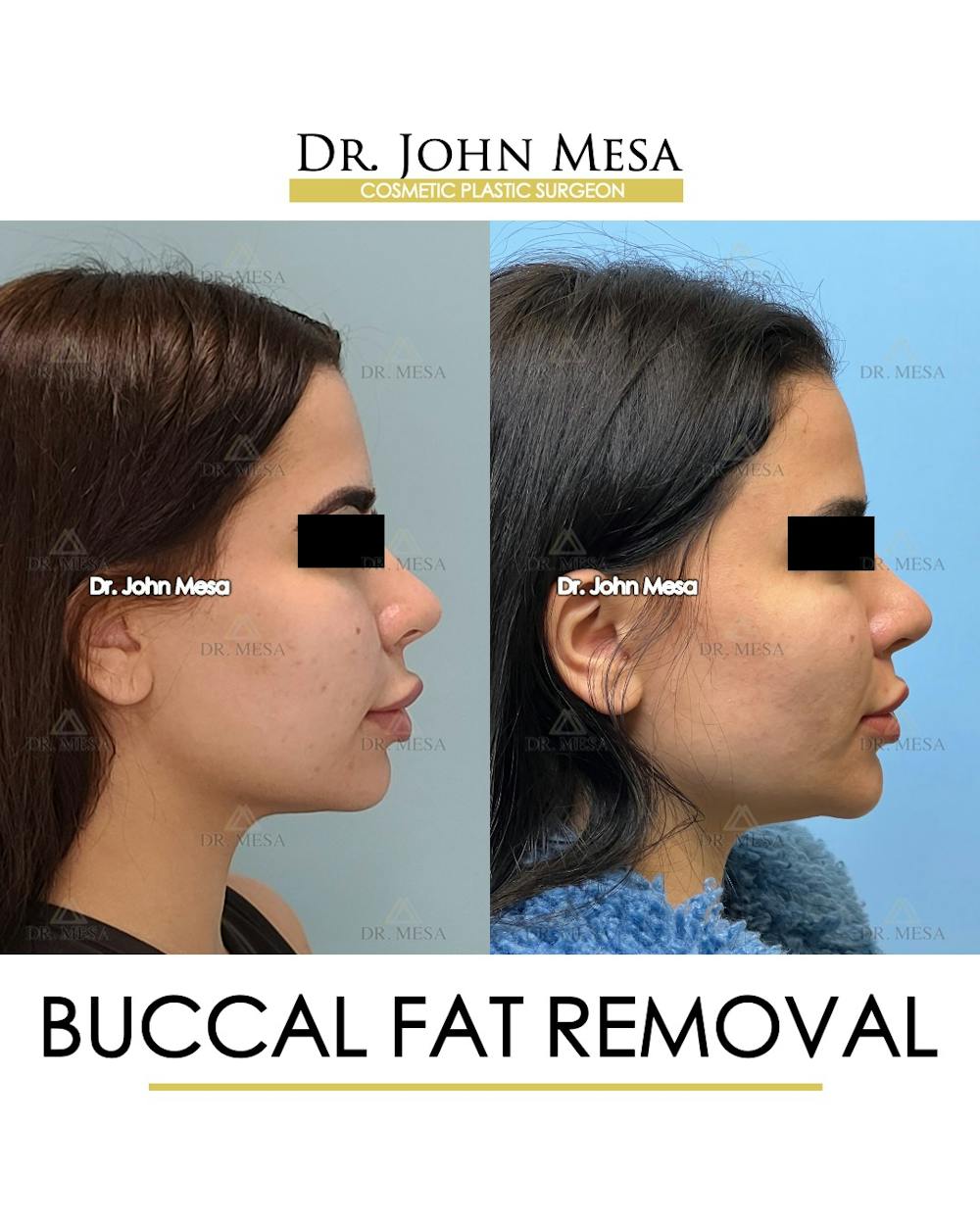 Buccal Fat Pad Removal Before & After Gallery - Patient 387573 - Image 3