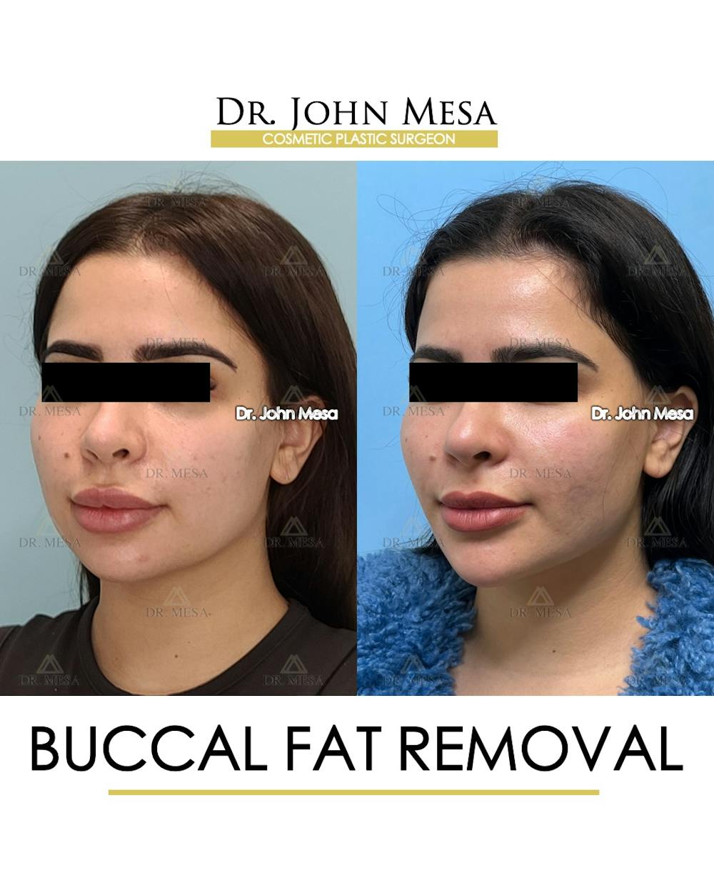Buccal Fat Pad Removal Before & After Gallery - Patient 387573 - Image 4