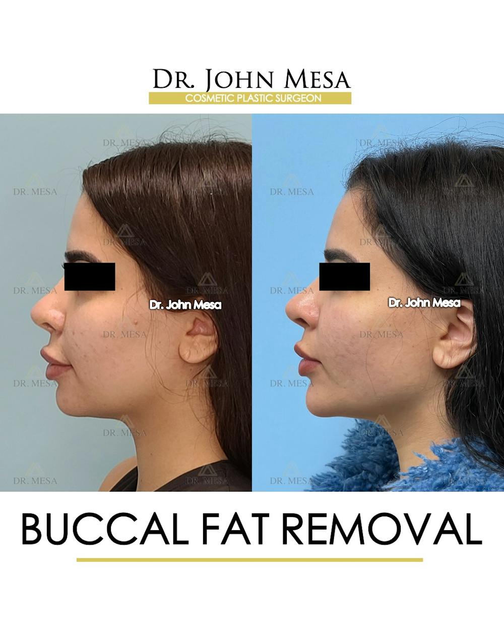 Buccal Fat Pad Removal Before & After Gallery - Patient 387573 - Image 5