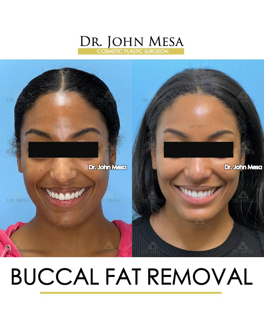 Buccal Fat Pad Removal Before & After Gallery - Patient 927675 - Image 2