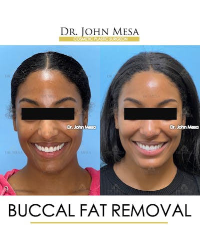 Buccal Fat Pad Removal Before & After Gallery - Patient 927675 - Image 2