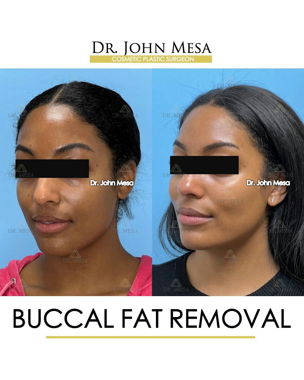Buccal Fat Pad Removal Before & After Gallery - Patient 927675 - Image 5