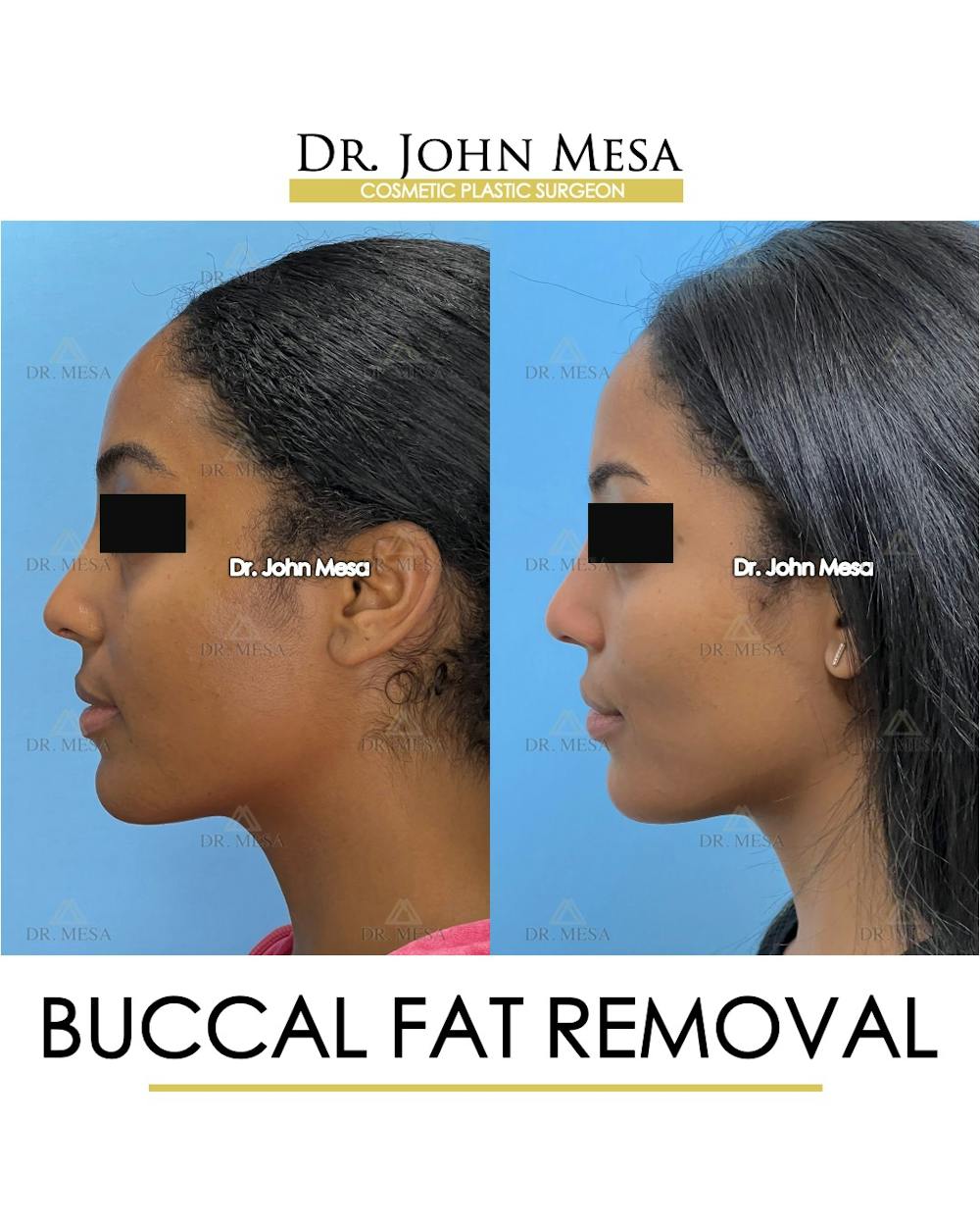 Buccal Fat Pad Removal Before & After Gallery - Patient 927675 - Image 6
