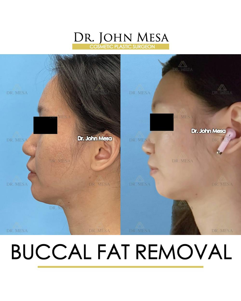 Buccal Fat Pad Removal Before & After Gallery - Patient 302040 - Image 5