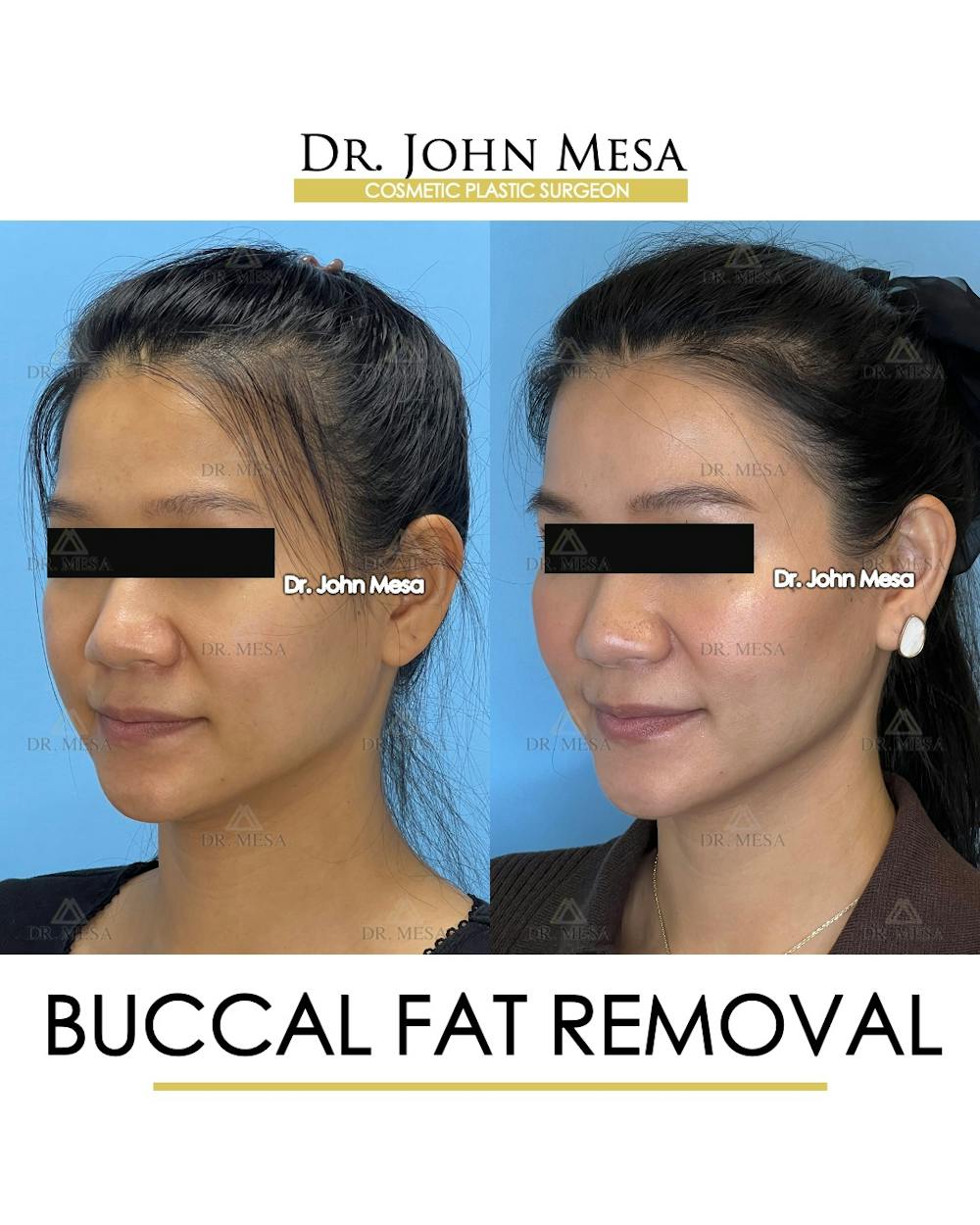 Buccal Fat Pad Removal Before & After Gallery - Patient 278613 - Image 5