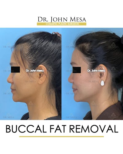 Buccal Fat Pad Removal Before & After Gallery - Patient 278613 - Image 6