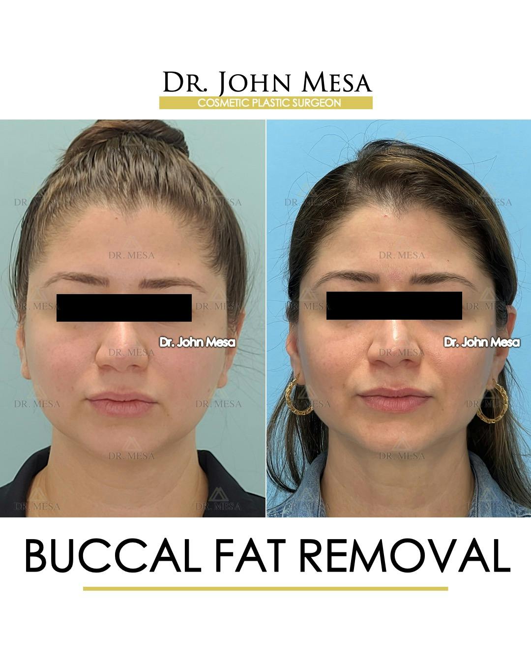 Buccal Fat Pad Removal Before & After Gallery - Patient 163284 - Image 1