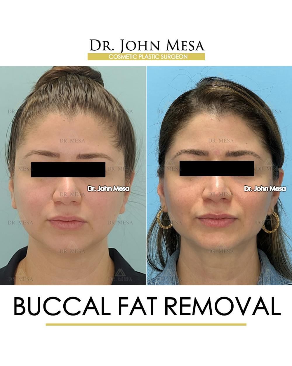 Buccal Fat Pad Removal Before & After Gallery - Patient 163284 - Image 1