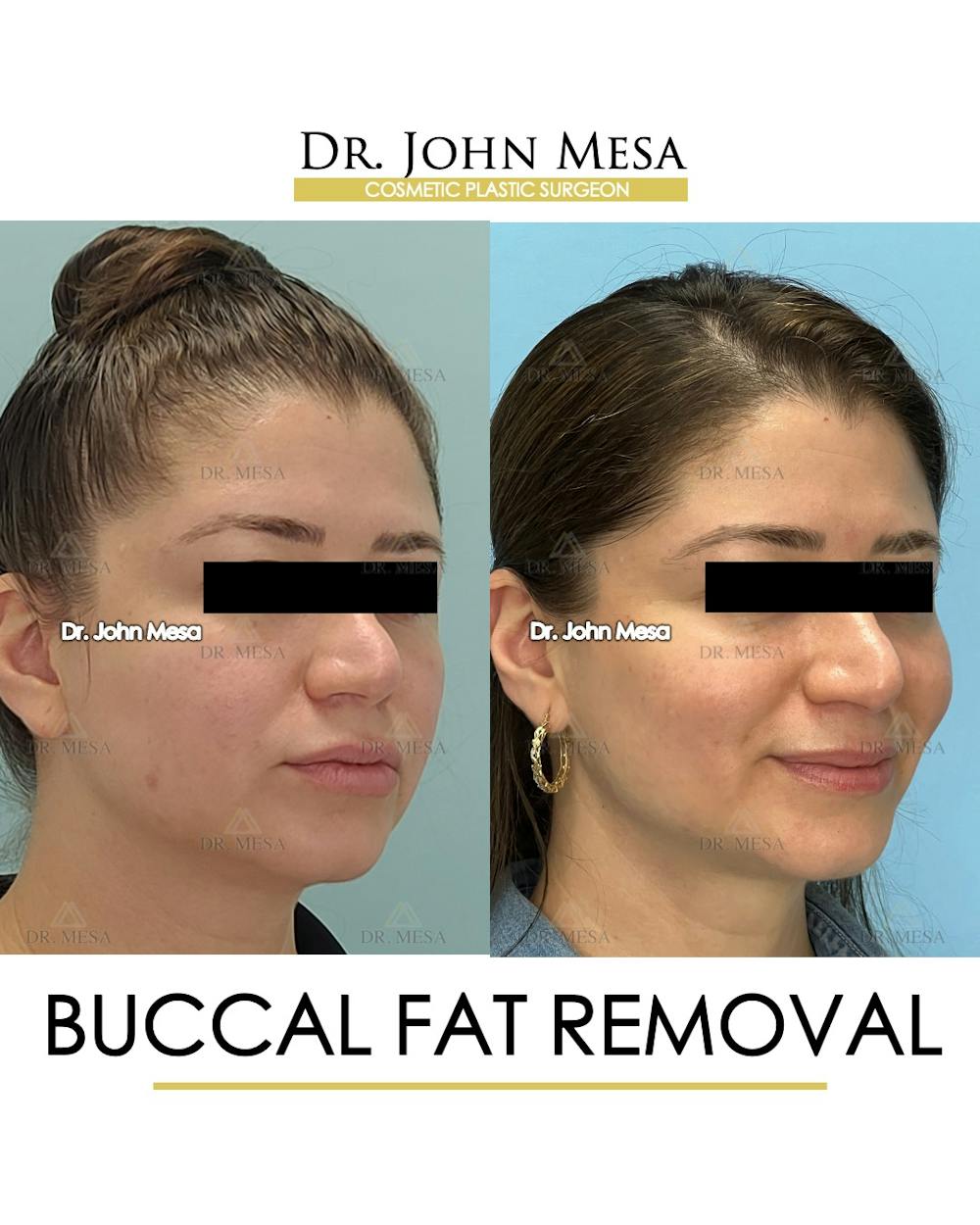 Buccal Fat Pad Removal Before & After Gallery - Patient 163284 - Image 2