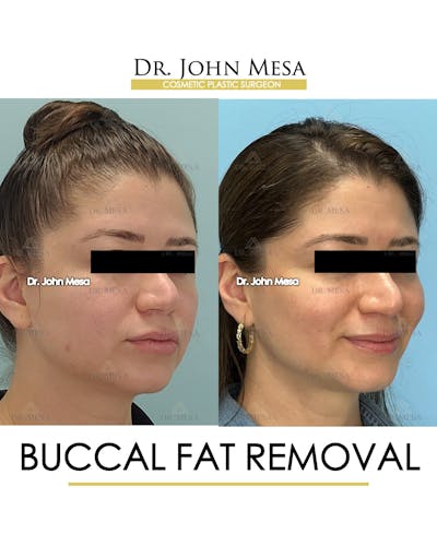 Buccal Fat Pad Removal Before & After Gallery - Patient 163284 - Image 2