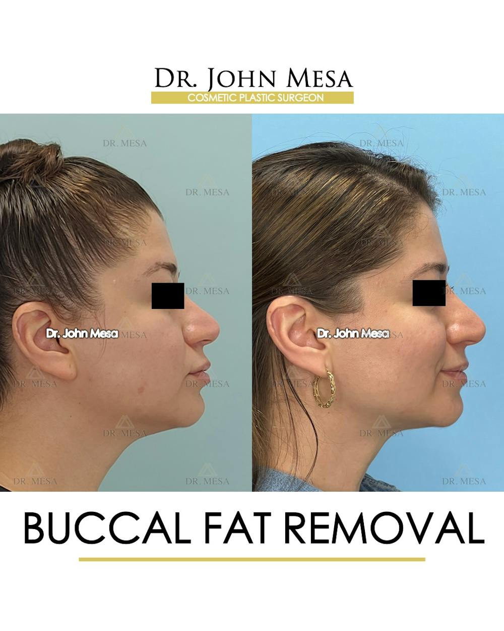 Buccal Fat Pad Removal Before & After Gallery - Patient 163284 - Image 3