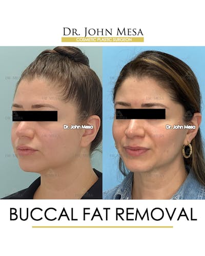 Buccal Fat Pad Removal Before & After Gallery - Patient 163284 - Image 4