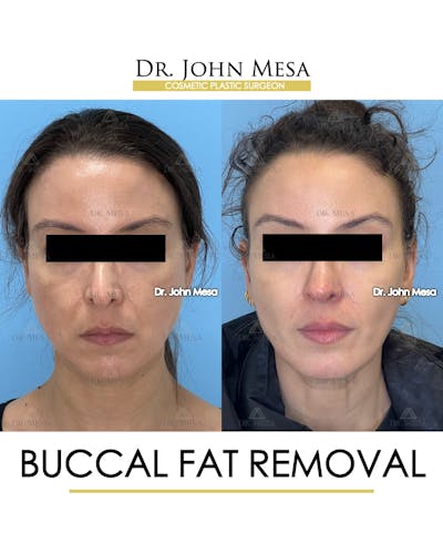 Buccal Fat Pad Removal Before & After Gallery - Patient 158969 - Image 1