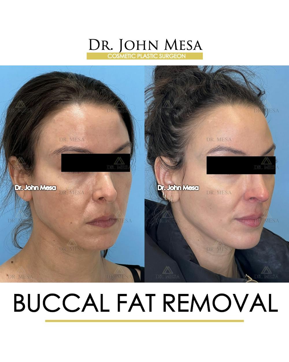 Buccal Fat Pad Removal Before & After Gallery - Patient 158969 - Image 2