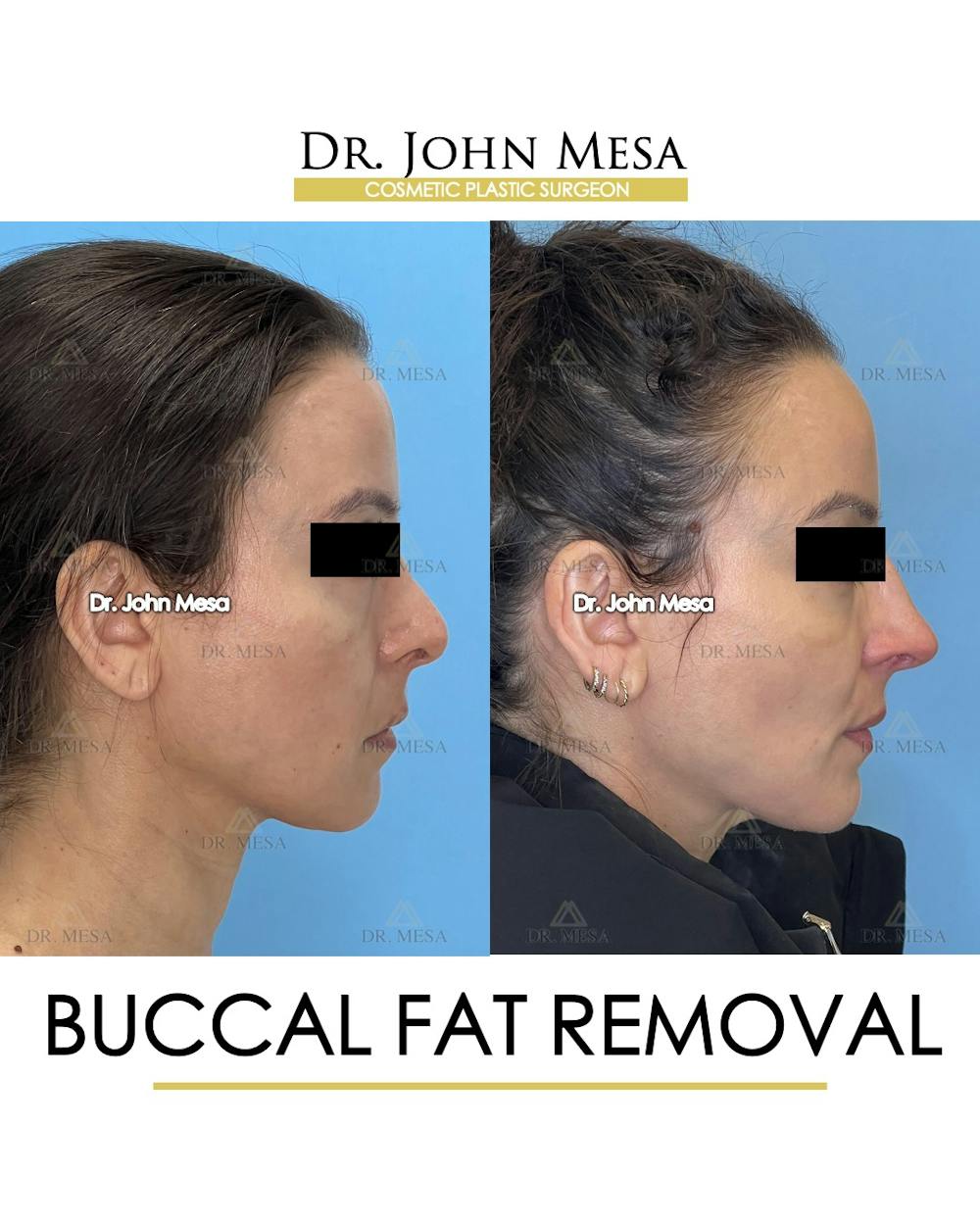 Buccal Fat Pad Removal Before & After Gallery - Patient 158969 - Image 3