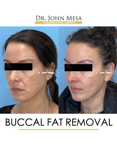 Buccal Fat Pad Removal Before & After Gallery - Patient 158969 - Image 4