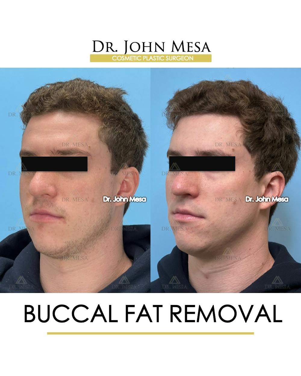 Buccal Fat Pad Removal for Men Before & After Gallery - Patient 127636 - Image 5
