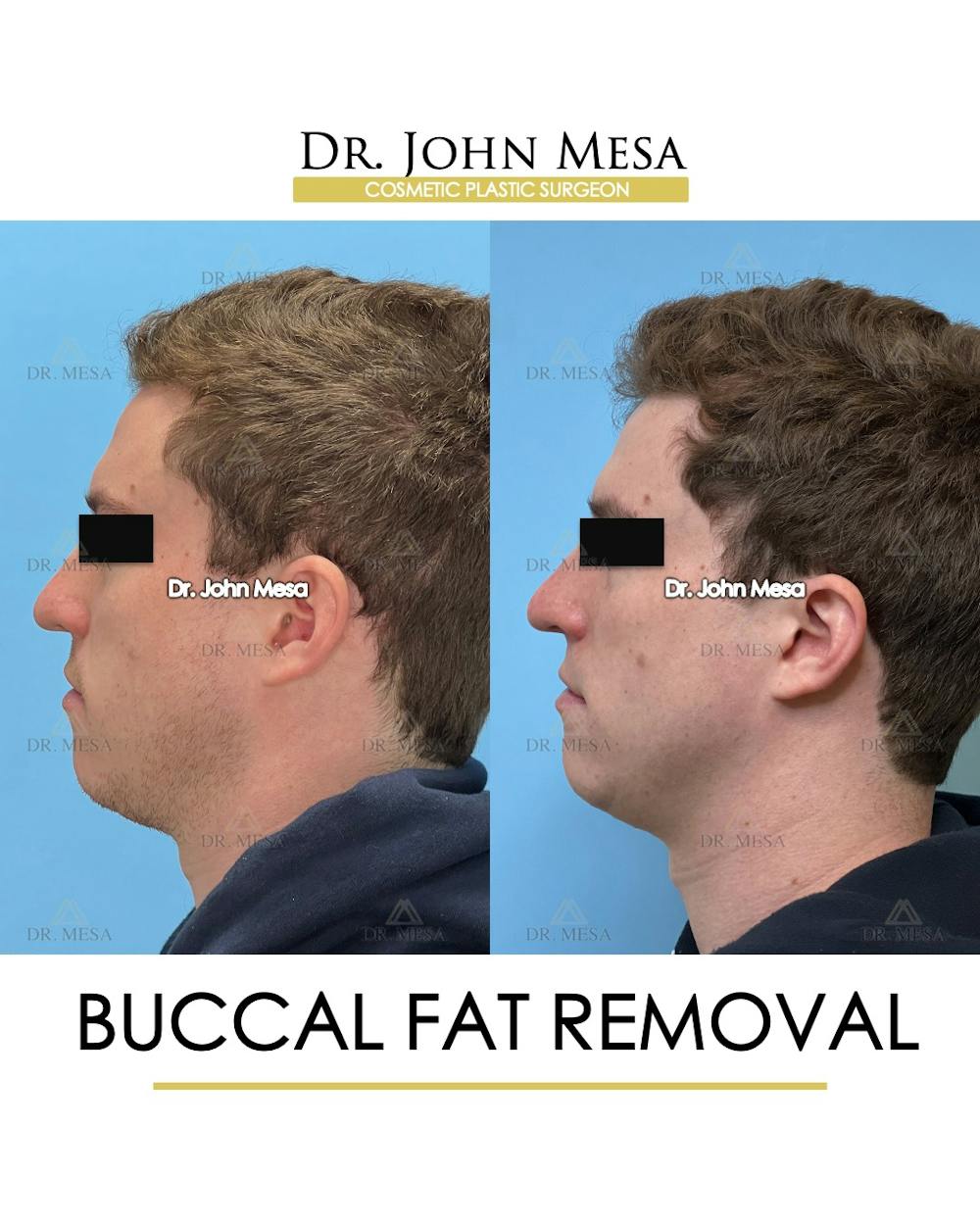 Buccal Fat Pad Removal for Men Before & After Gallery - Patient 127636 - Image 6