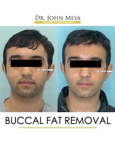Buccal Fat Pad Removal for Men Before & After Gallery - Patient 245296 - Image 1
