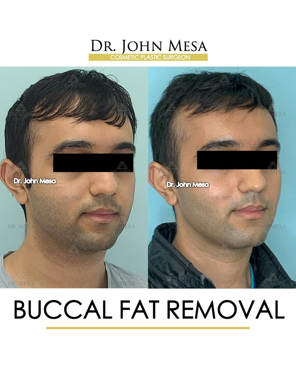 Buccal Fat Pad Removal for Men Before & After Gallery - Patient 245296 - Image 2