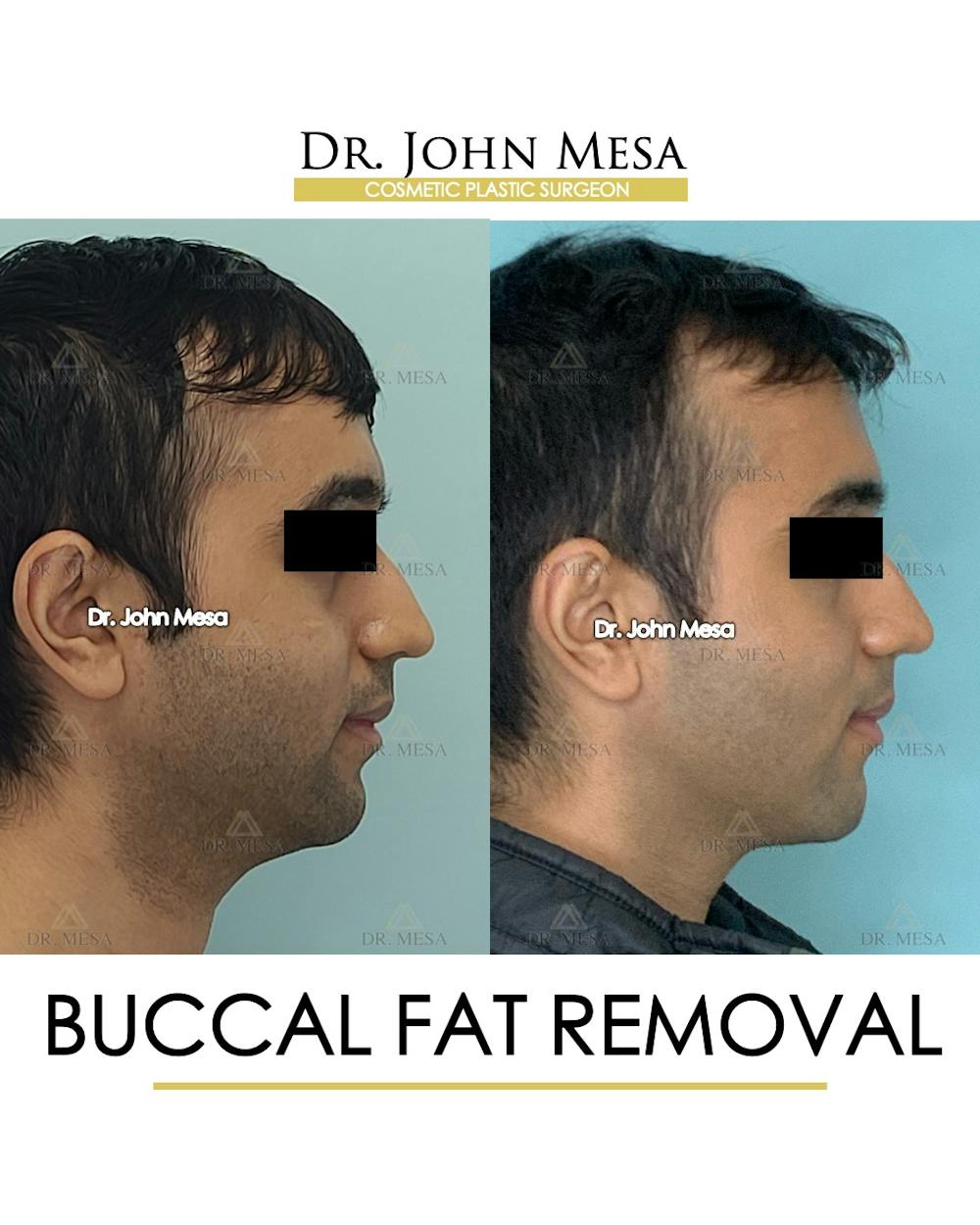 Buccal Fat Pad Removal for Men Before & After Gallery - Patient 245296 - Image 3