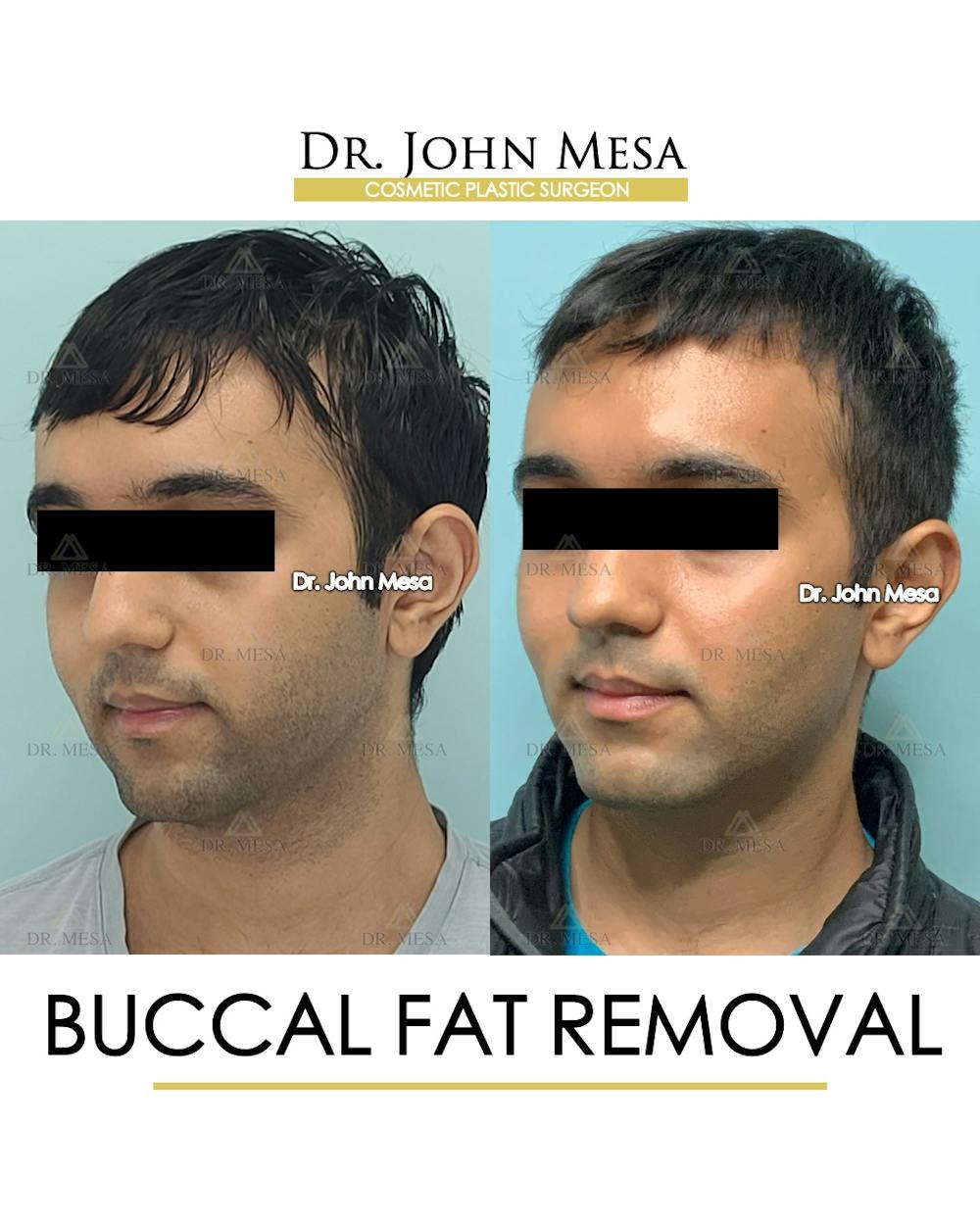 Buccal Fat Pad Removal for Men Before & After Gallery - Patient 245296 - Image 4