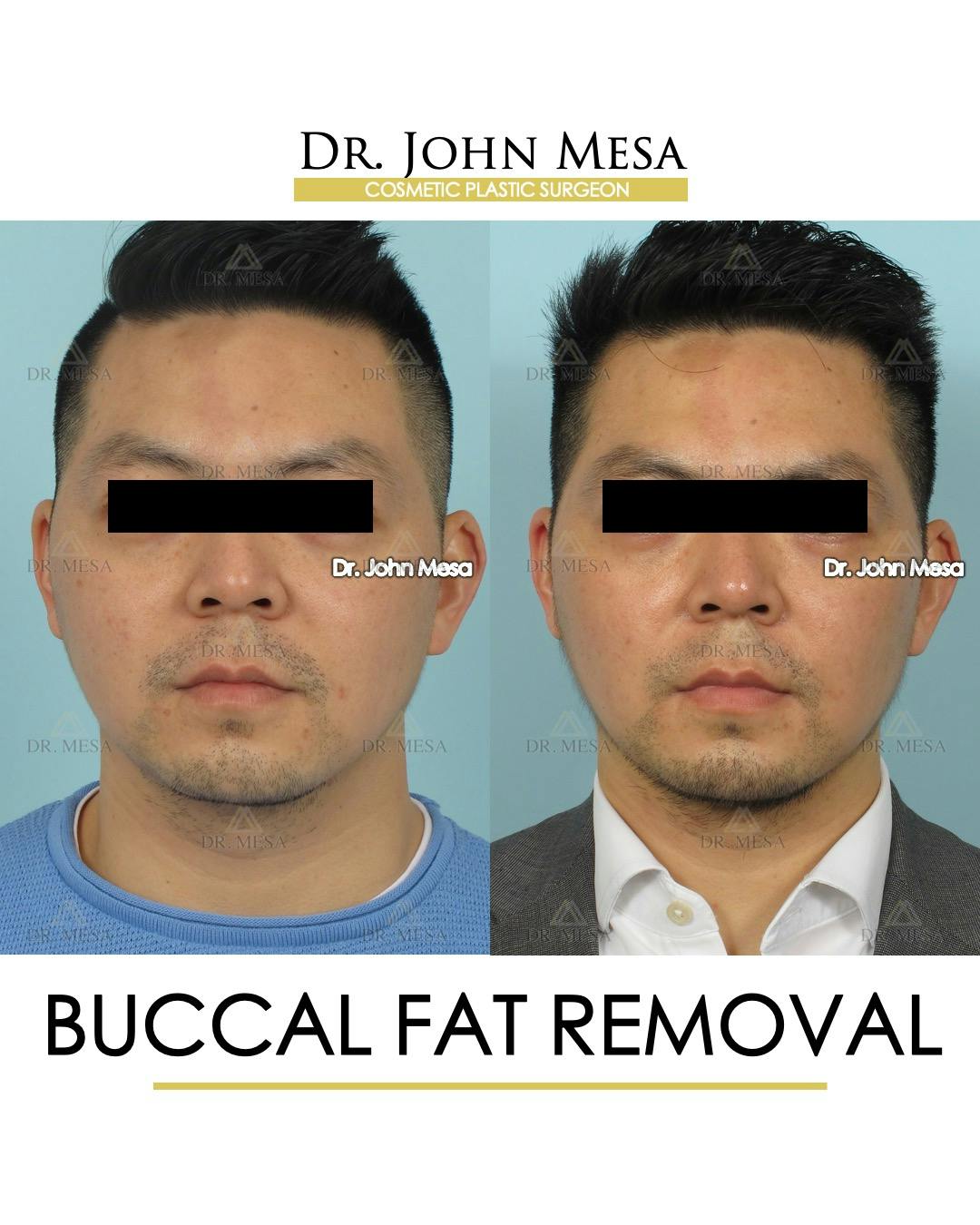 Buccal Fat Pad Removal for Men Before & After Gallery - Patient 248585 - Image 1