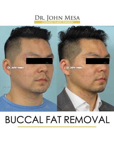 Buccal Fat Pad Removal for Men Before & After Gallery - Patient 248585 - Image 2