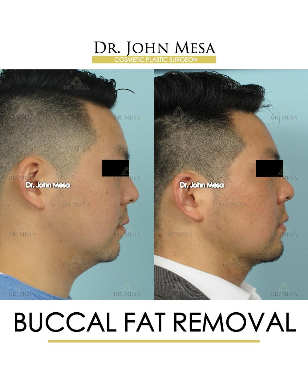 Buccal Fat Pad Removal for Men Before & After Gallery - Patient 248585 - Image 3