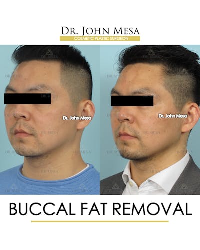Buccal Fat Pad Removal for Men Before & After Gallery - Patient 248585 - Image 4