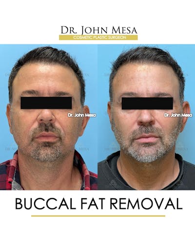Buccal Fat Pad Removal for Men Before & After Gallery - Patient 154763 - Image 1
