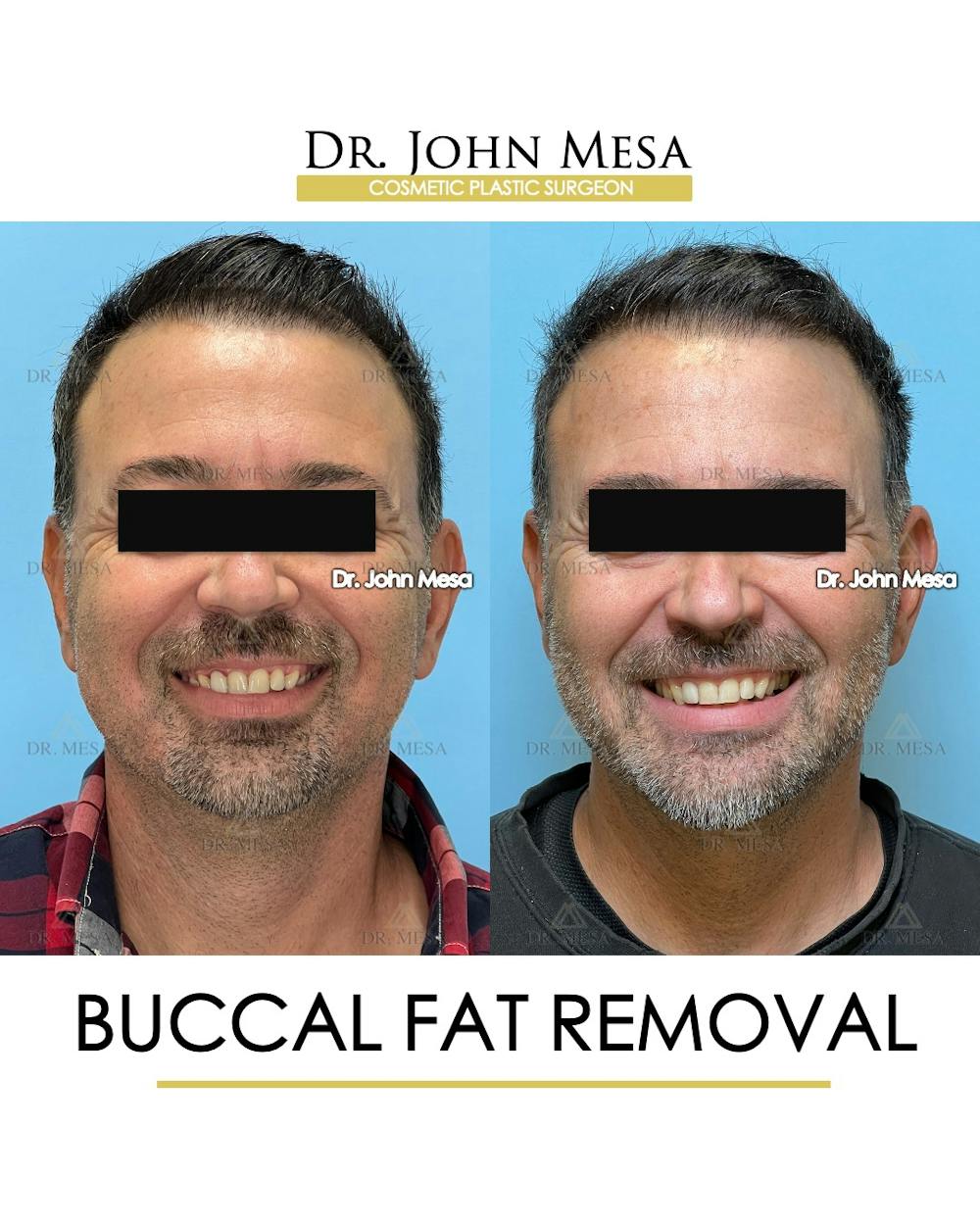 Buccal Fat Pad Removal for Men Before & After Gallery - Patient 154763 - Image 2
