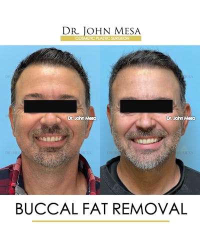 Buccal Fat Pad Removal for Men Before & After Gallery - Patient 154763 - Image 2