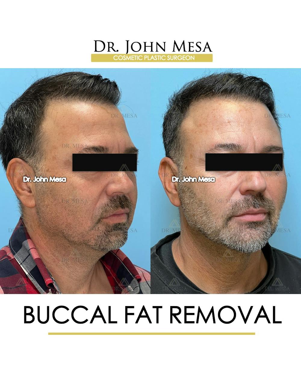 Buccal Fat Pad Removal for Men Before & After Gallery - Patient 154763 - Image 3