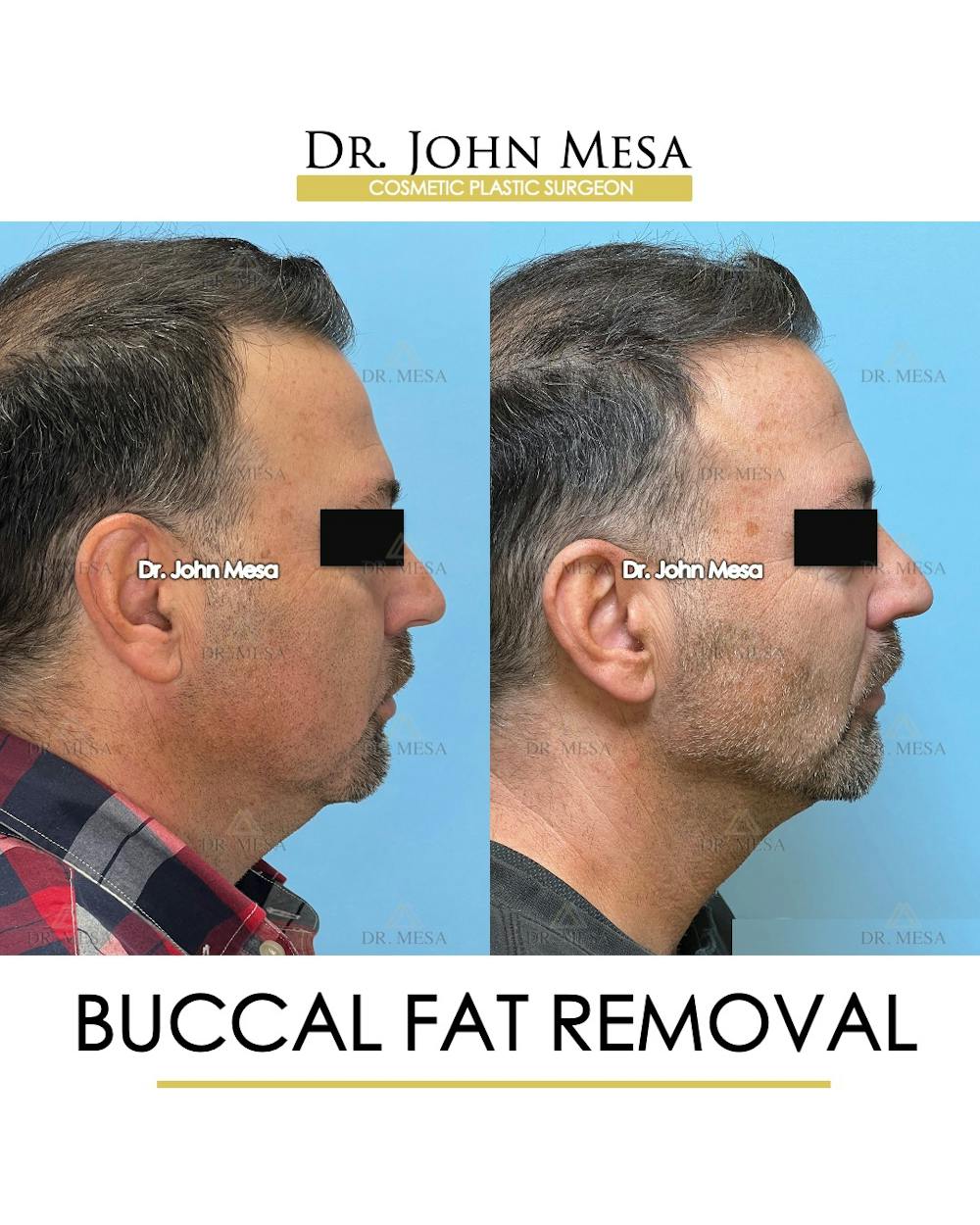 Buccal Fat Pad Removal for Men Before & After Gallery - Patient 154763 - Image 4