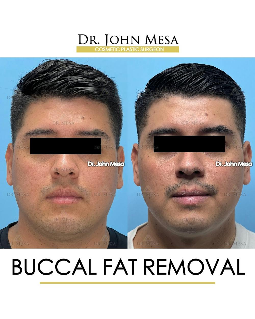 Buccal Fat Pad Removal for Men Before & After Gallery - Patient 281102 - Image 1
