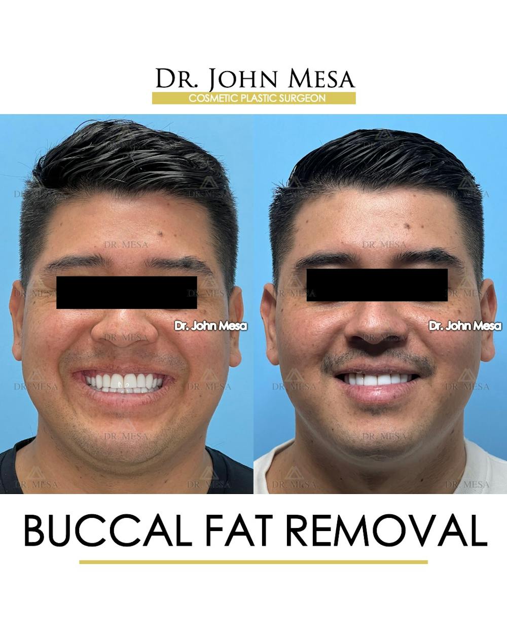 Buccal Fat Pad Removal for Men Before & After Gallery - Patient 281102 - Image 2