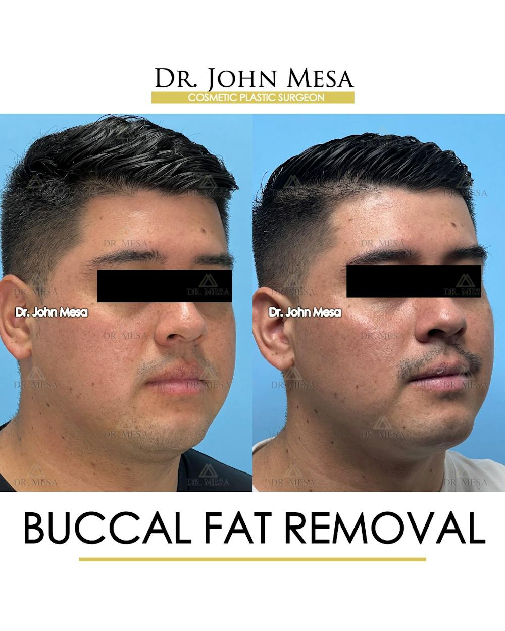 Buccal Fat Pad Removal for Men Before & After Gallery - Patient 281102 - Image 3