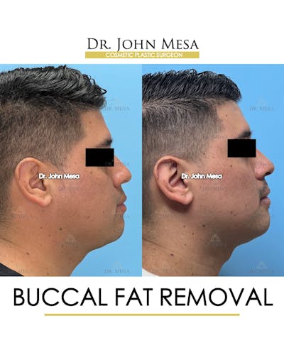 Buccal Fat Pad Removal for Men Before & After Gallery - Patient 281102 - Image 4