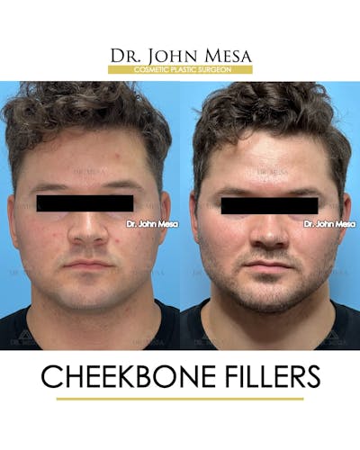 Cheekbone Filler Before & After Gallery - Patient 271647 - Image 1