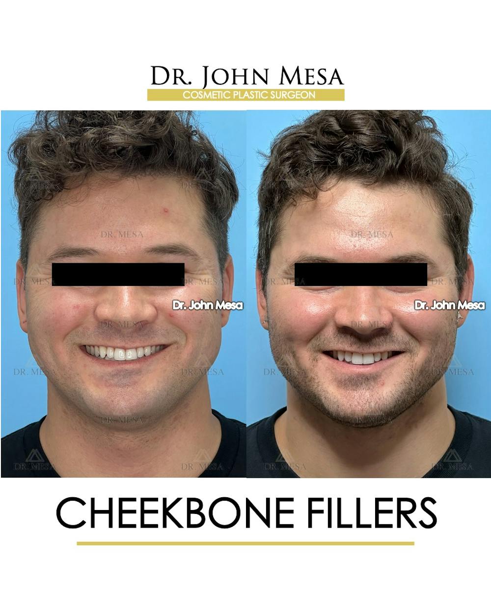 Cheekbone Filler Before & After Gallery - Patient 271647 - Image 2