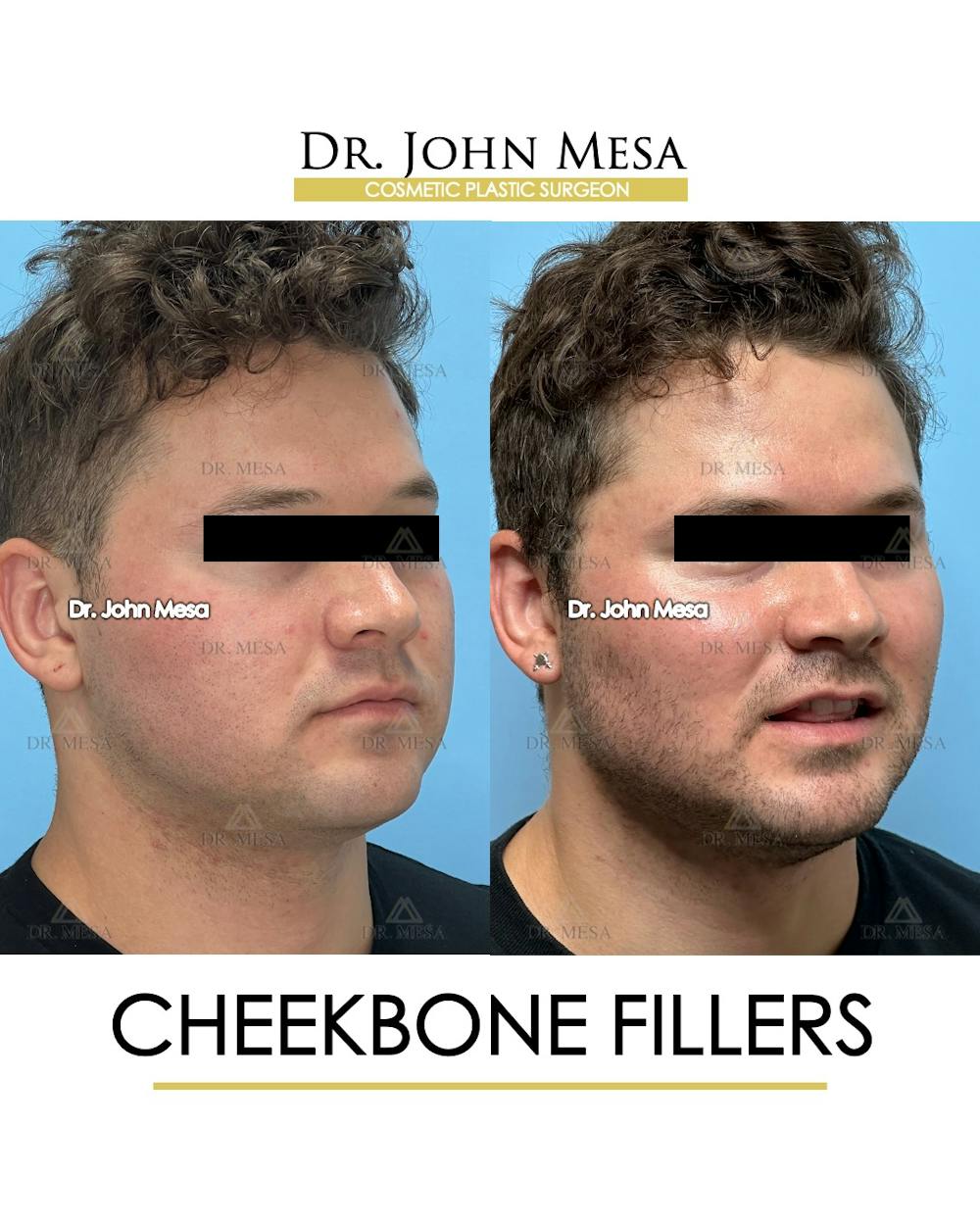 Cheekbone Filler Before & After Gallery - Patient 271647 - Image 3