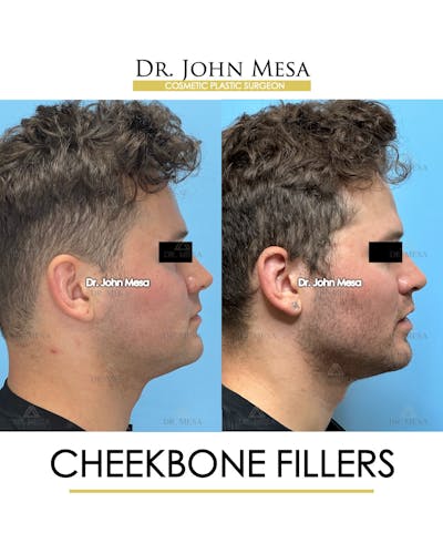 Cheekbone Filler Before & After Gallery - Patient 271647 - Image 4