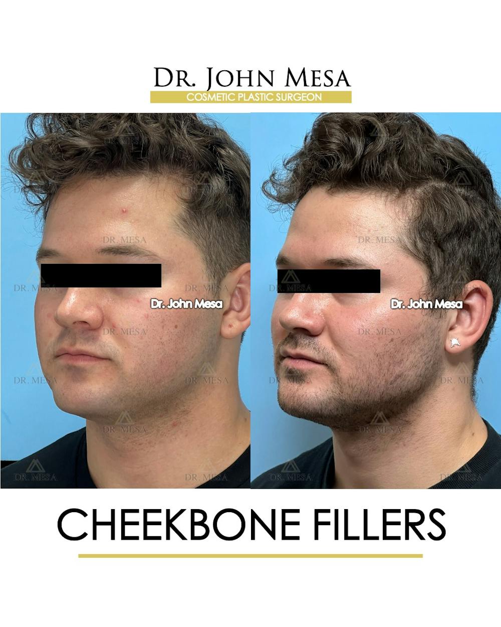 Cheekbone Filler Before & After Gallery - Patient 271647 - Image 5