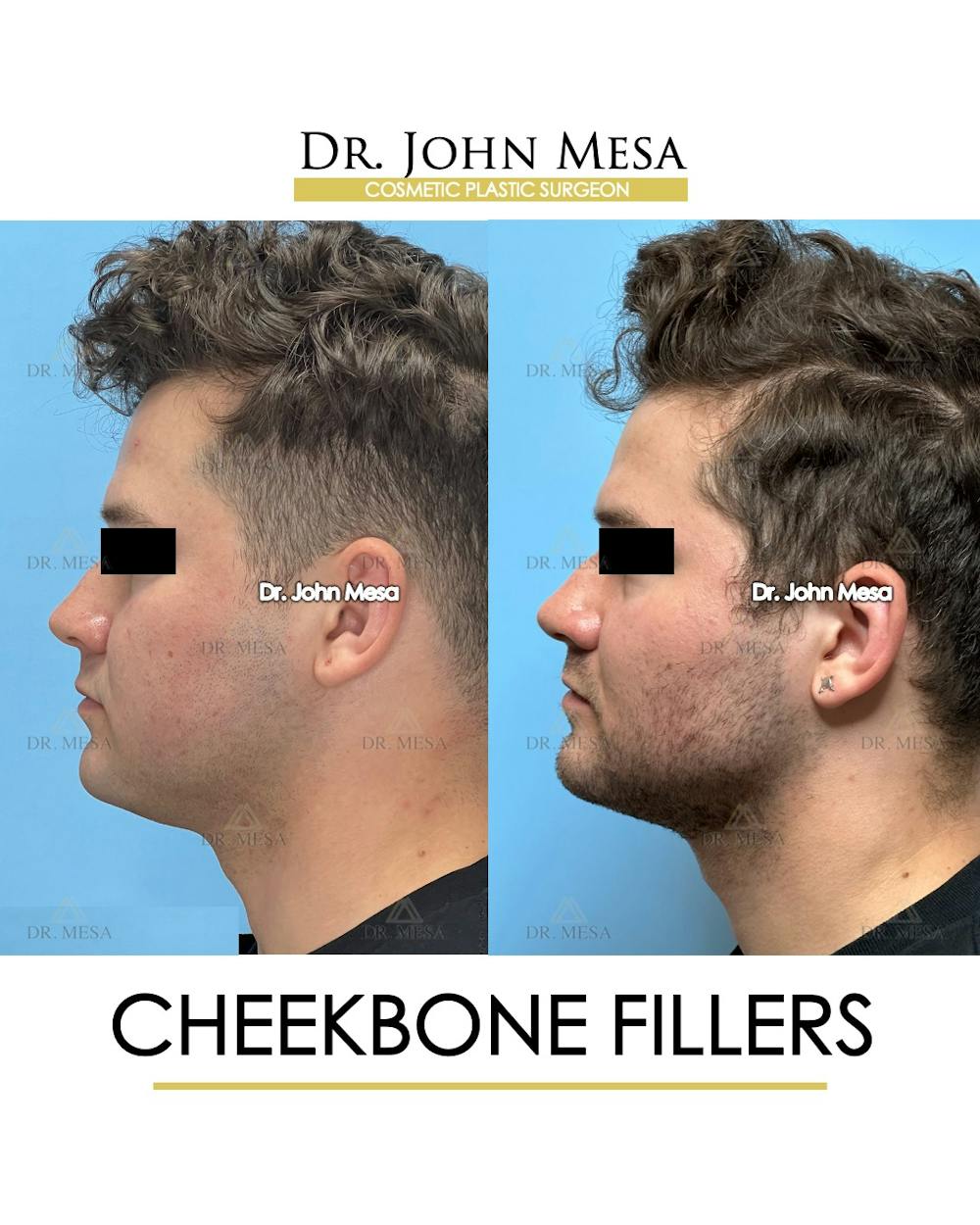 Cheekbone Filler Before & After Gallery - Patient 271647 - Image 6